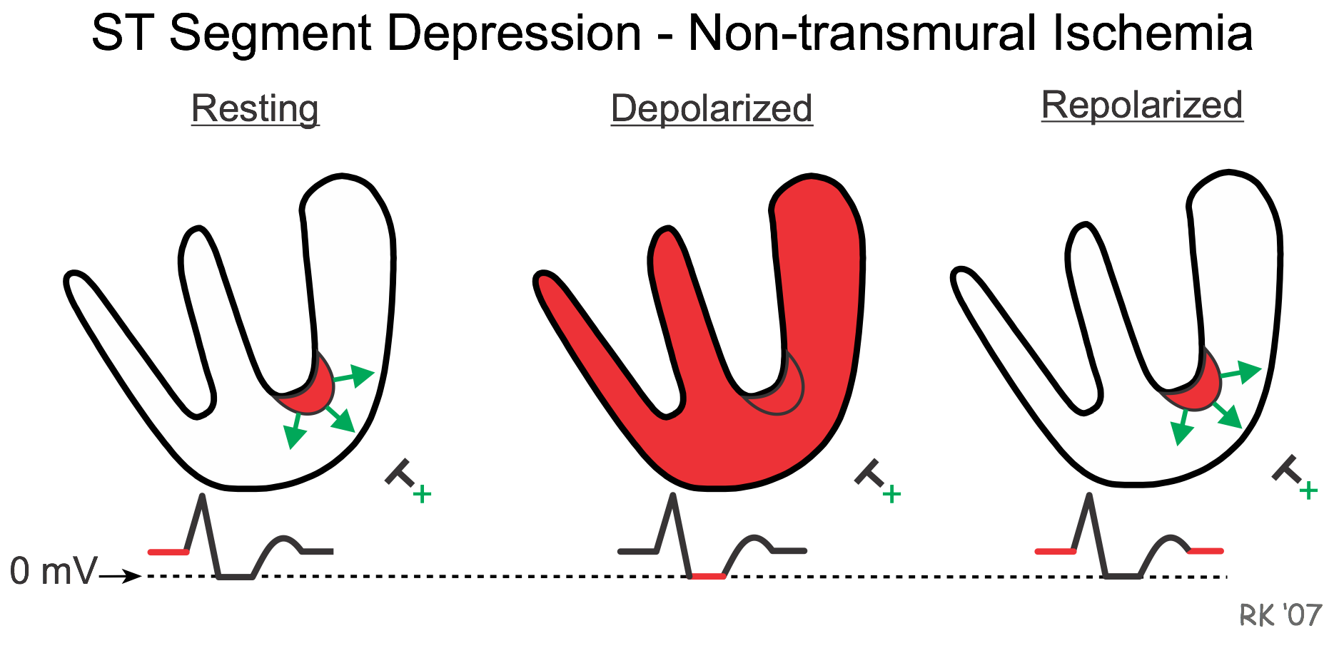 ST segment elevation and depression